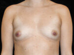 Breast Augmentation before and after results - Nashville patient - Before