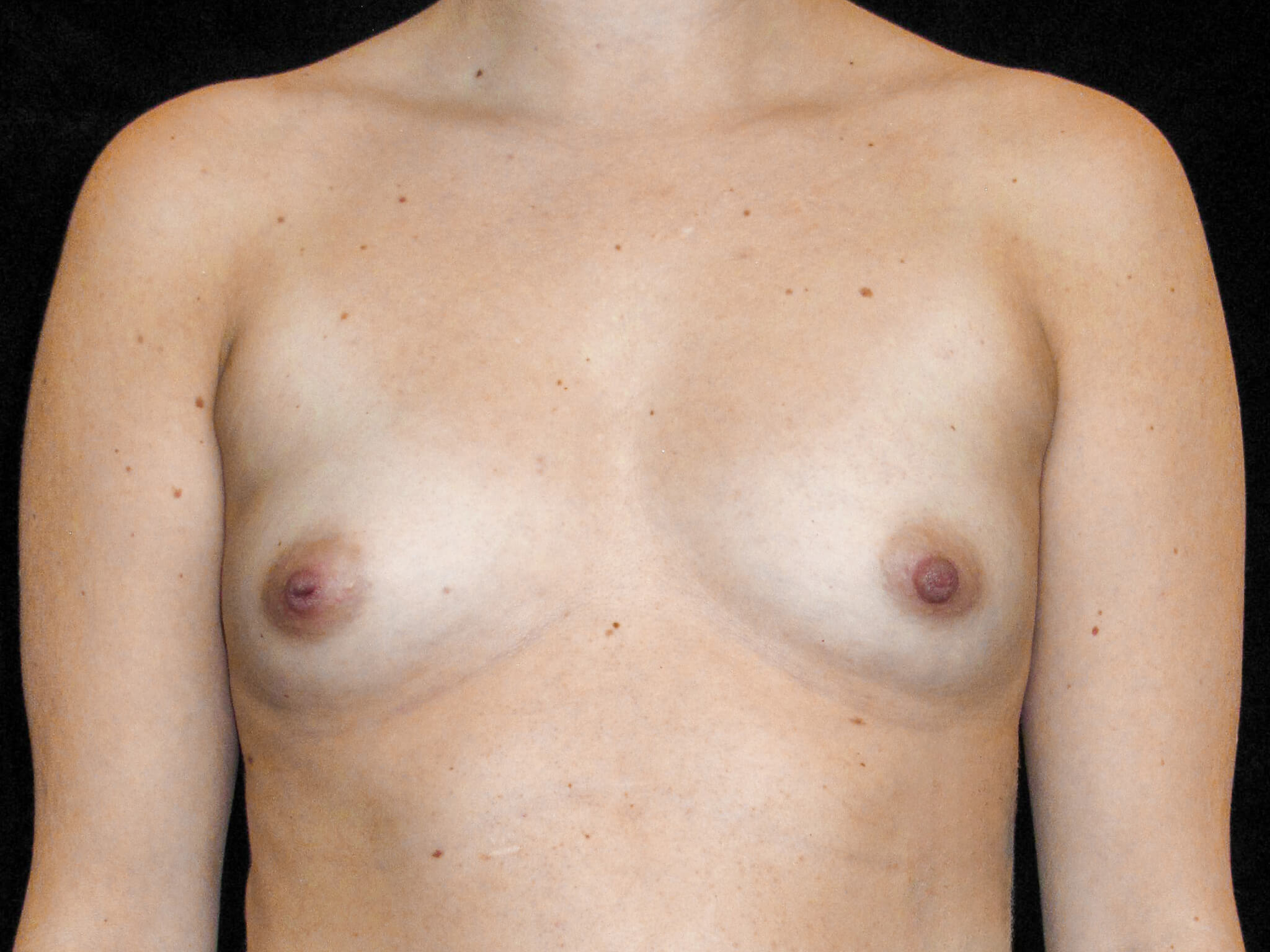 Breast Augmentation Patient Photo - Case 13072 - before view-