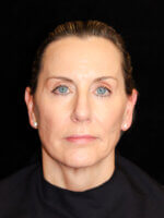 Facelift - Case 14704 - After