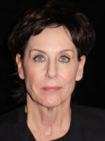 Facelift - Case 14704 - Before