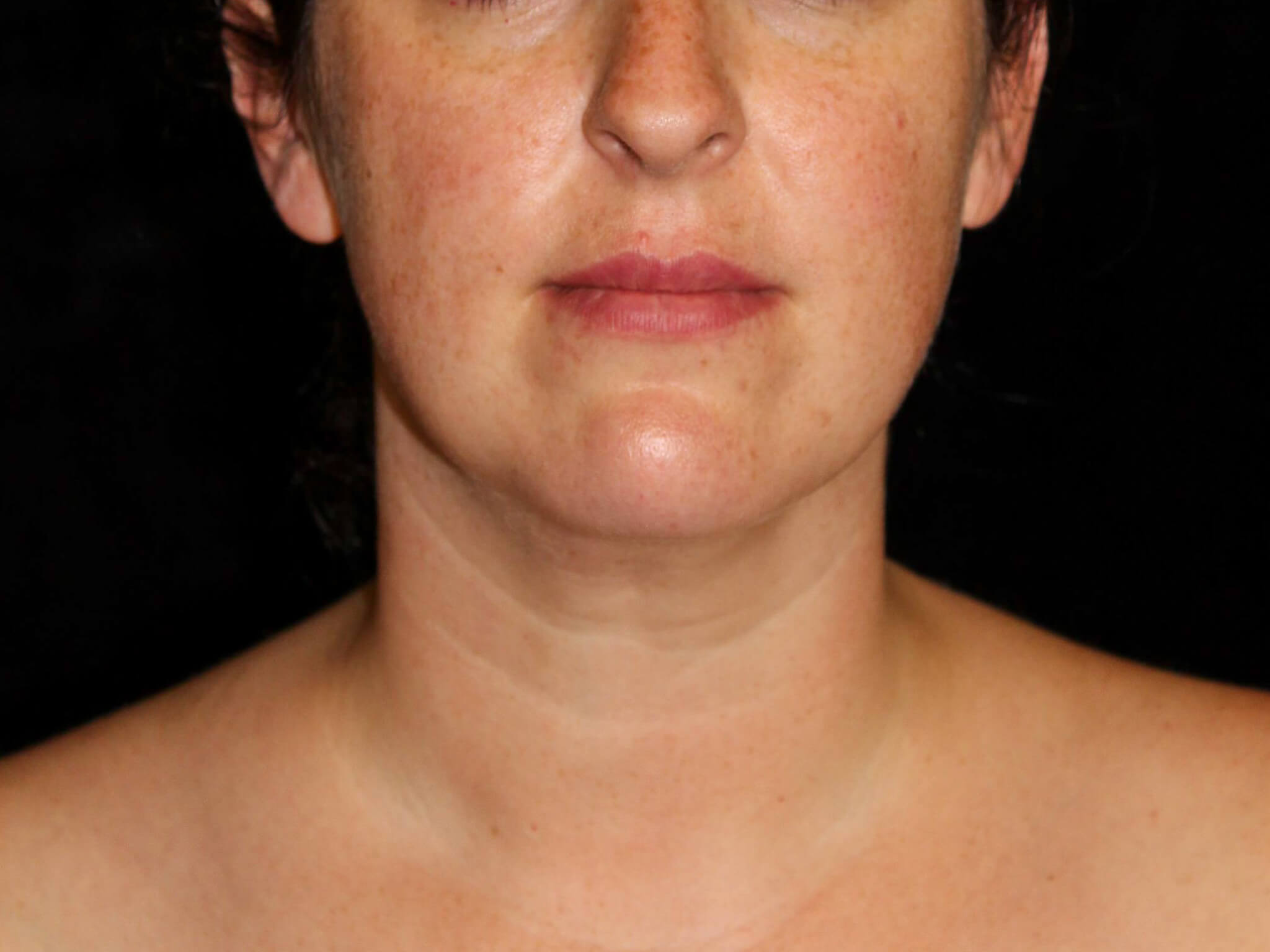 Facial Liposuction before and after results - Nashville patient - after