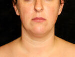 Facial Liposuction before and after results - Nashville patient - Before