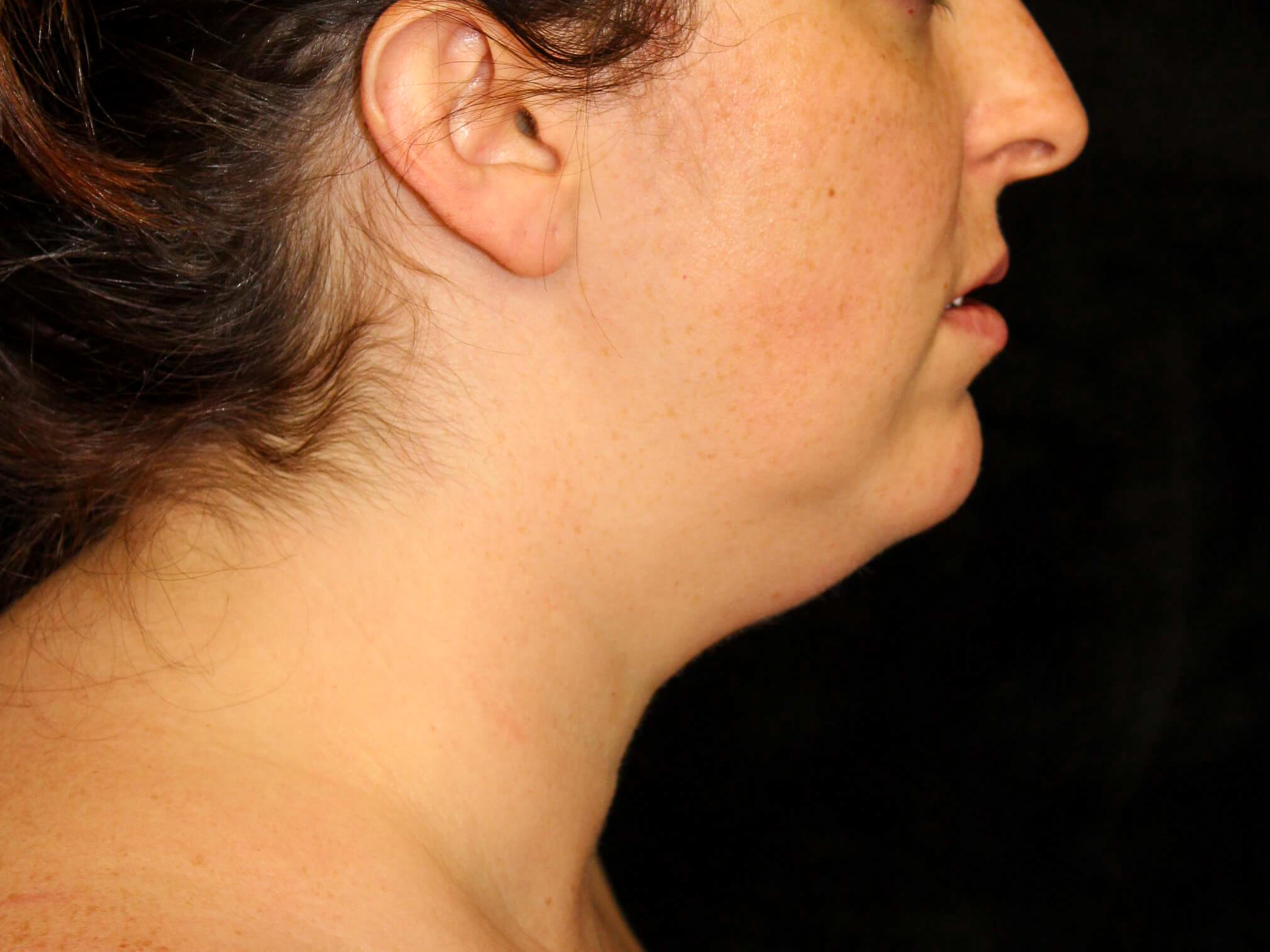 Facial Liposuction before and after results - Nashville patient - before view 3