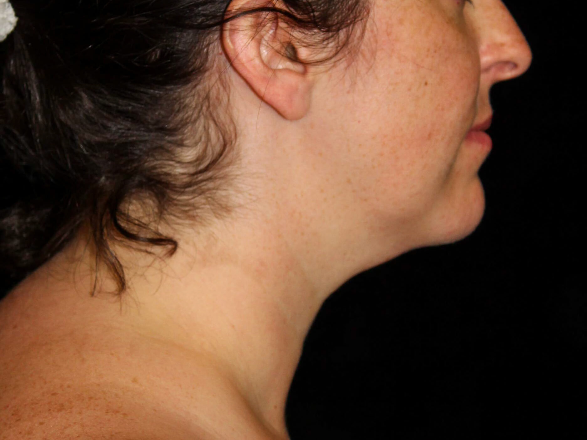 Facial Liposuction before and after results - Nashville patient - after view 3