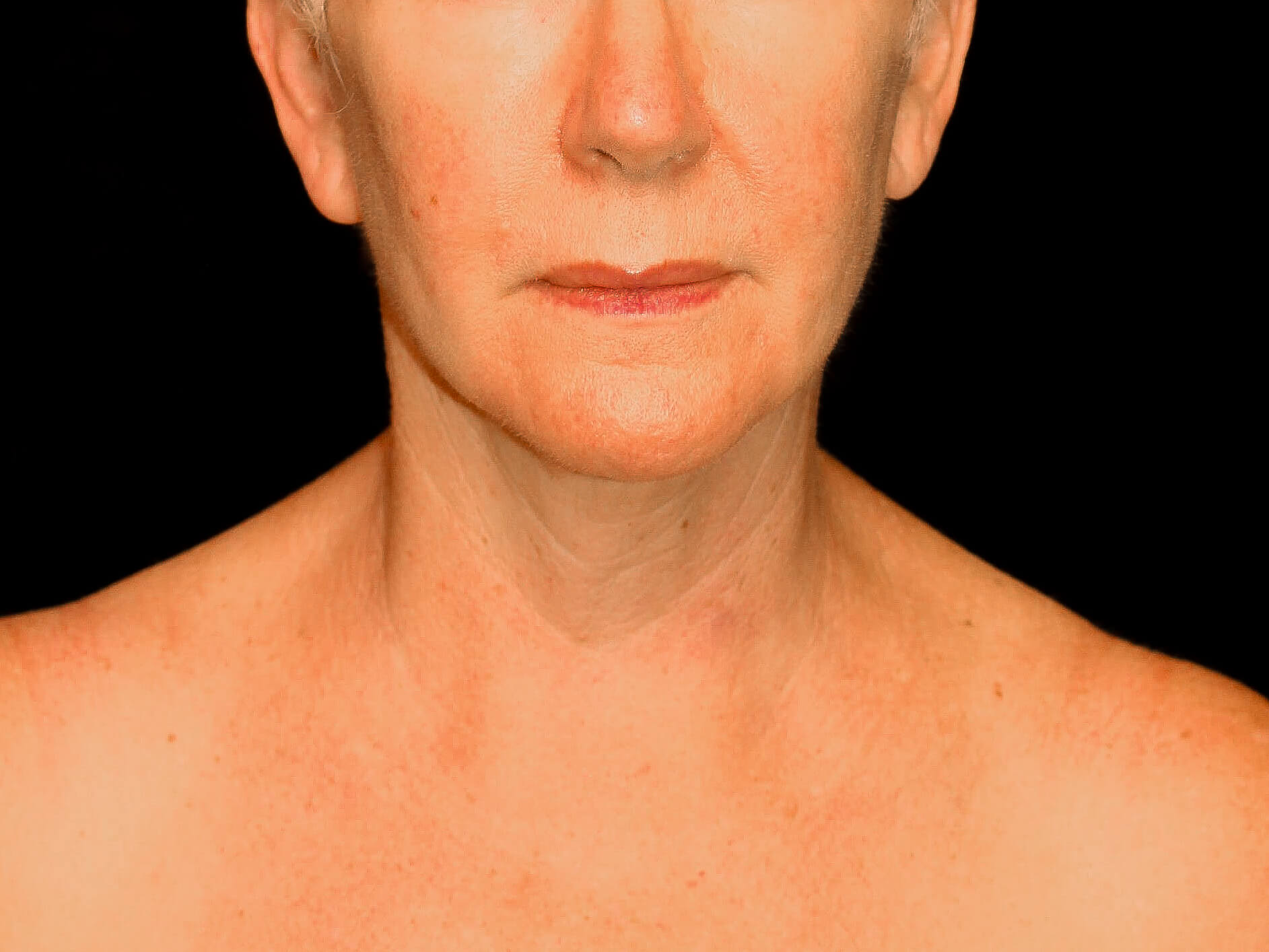 Facelift Patient Photo - Case 9776 - after view