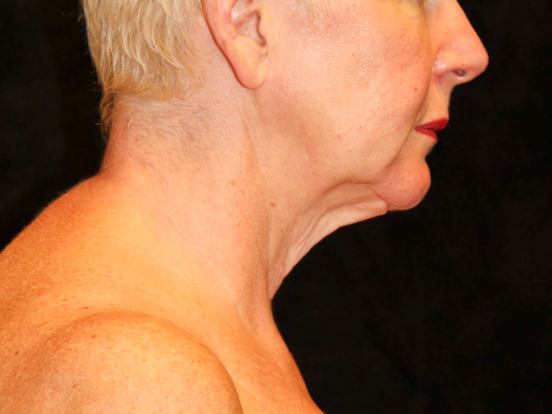 Facelift Patient Photo - Case 9776 - before view-2
