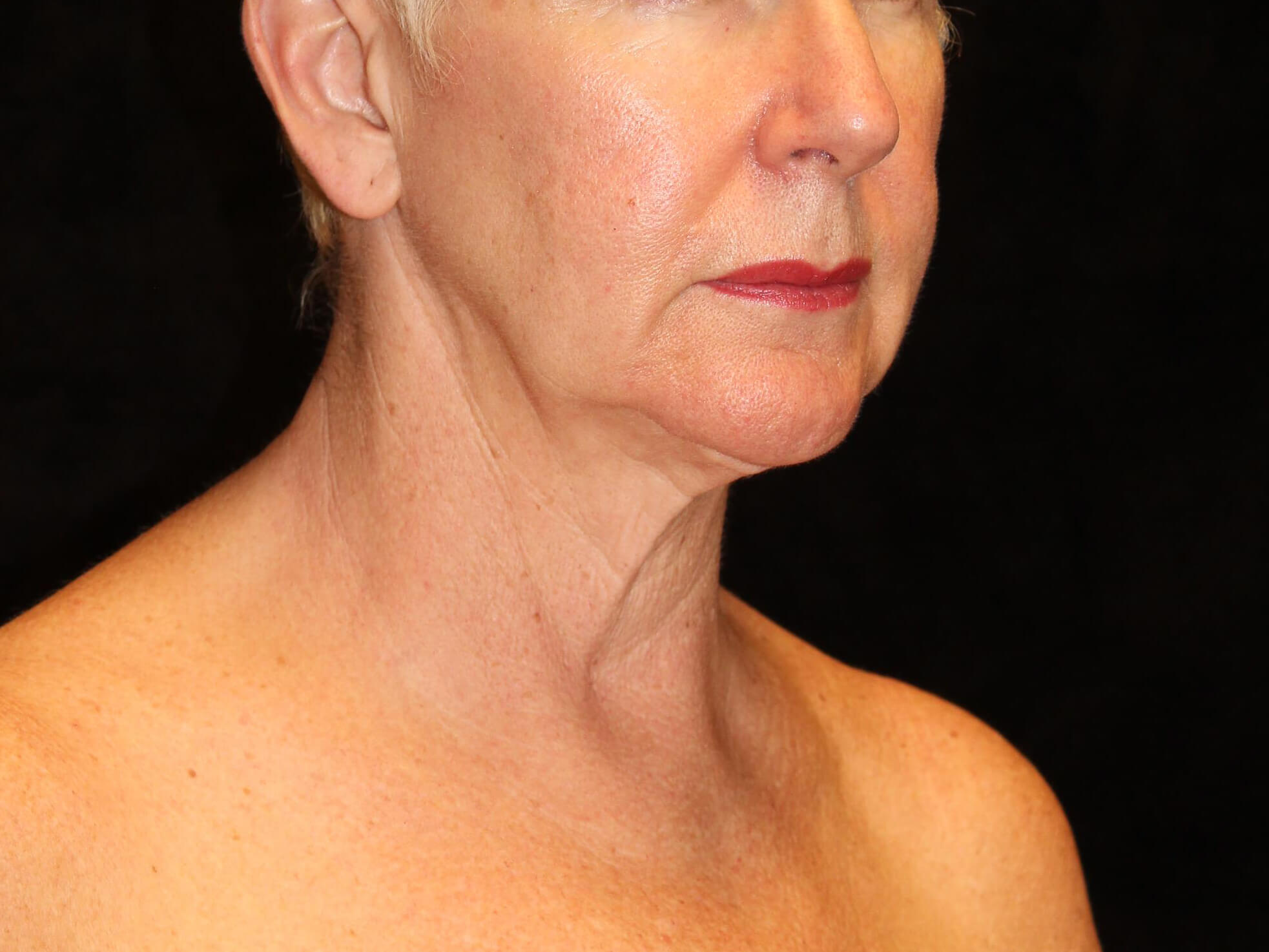 Facelift Patient Photo - Case 9776 - before view-1