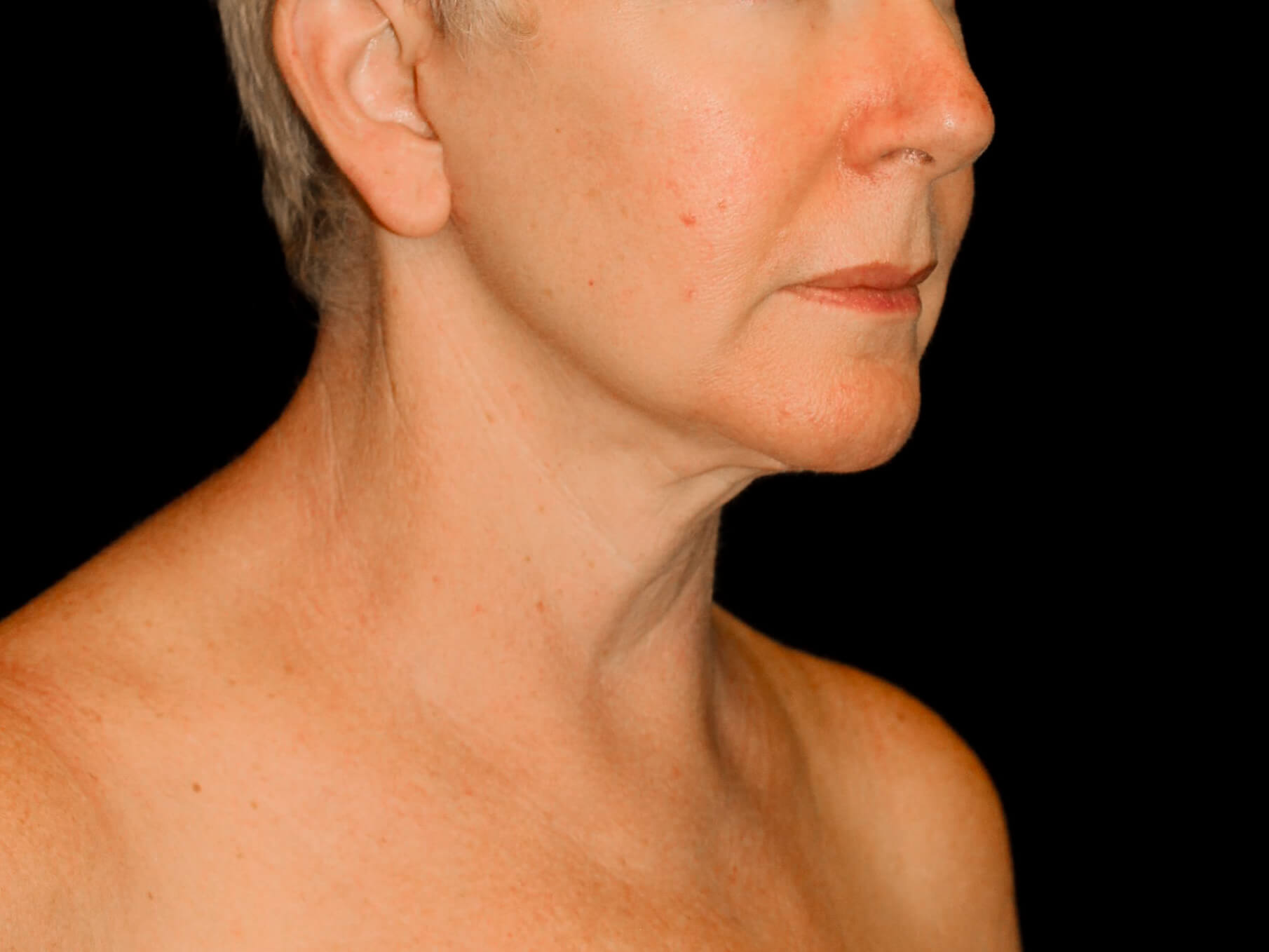 Facelift Patient Photo - Case 9776 - after view-1