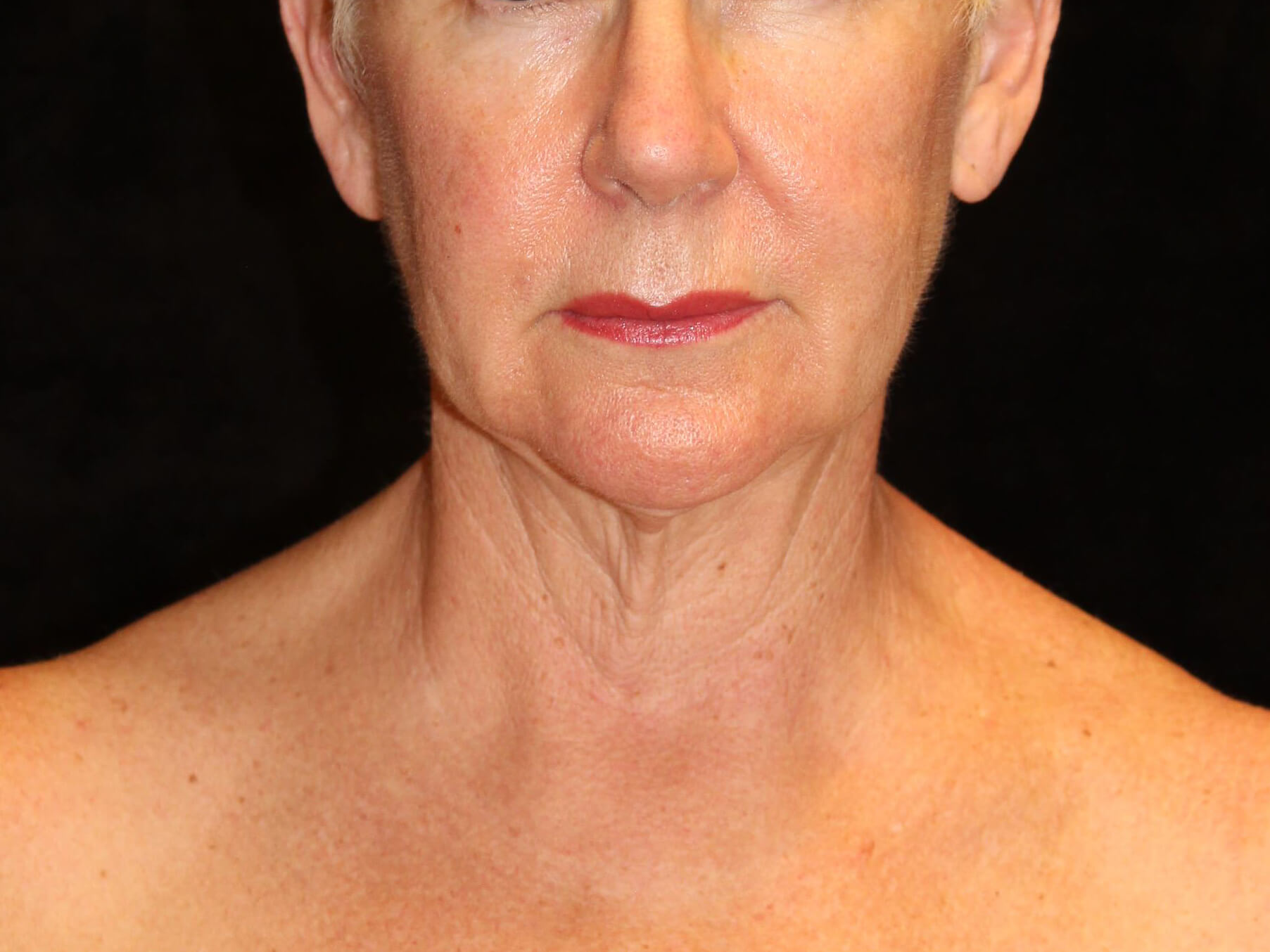 Facelift Patient Photo - Case 9776 - before view-