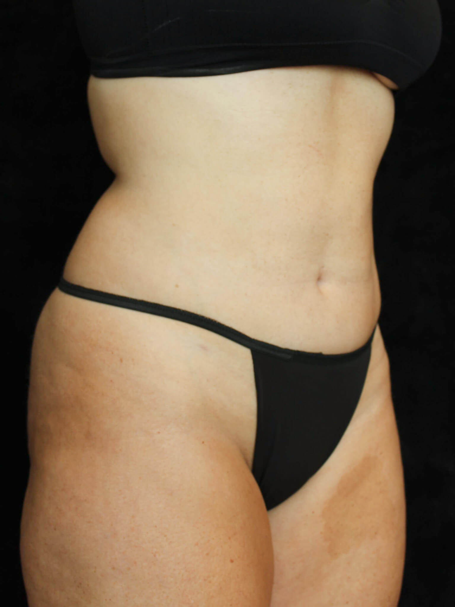 Liposuction Patient Photo - Case 16285 - after view-1