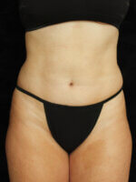 Liposuction before and after results - Nashville patient - After