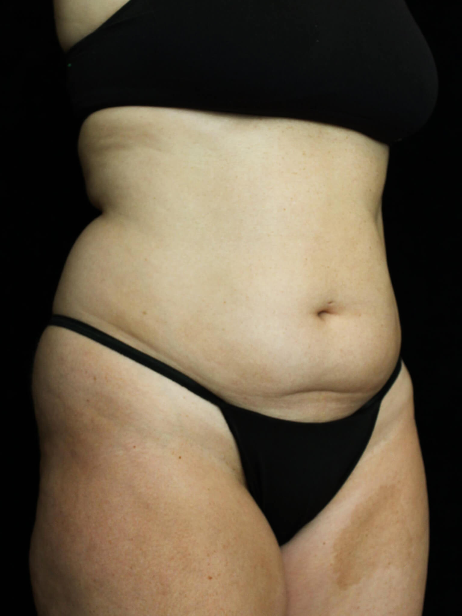Liposuction Patient Photo - Case 16285 - before view-1