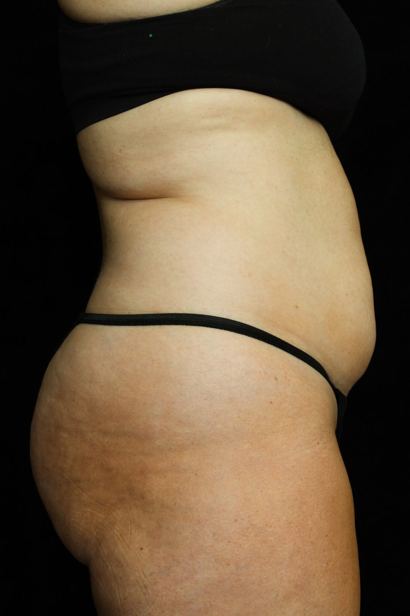 Liposuction Patient Photo - Case 16285 - before view-2