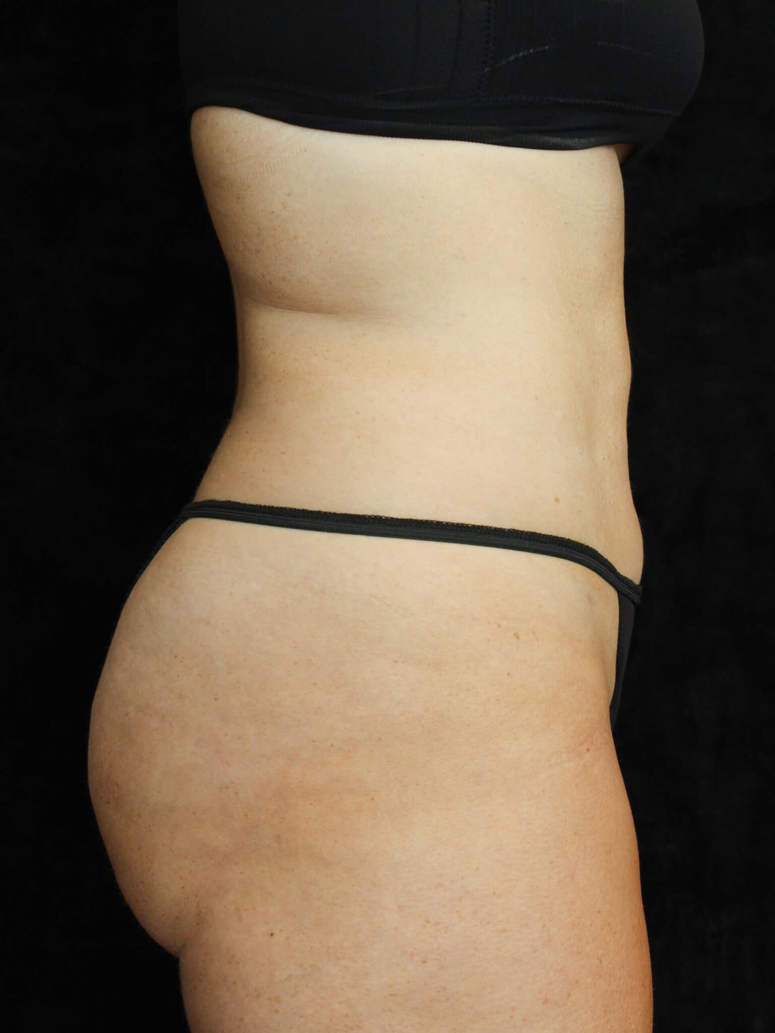 Liposuction Patient Photo - Case 16285 - after view-2