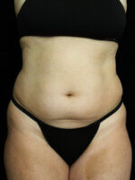 Liposuction before and after results - Nashville patient - Before