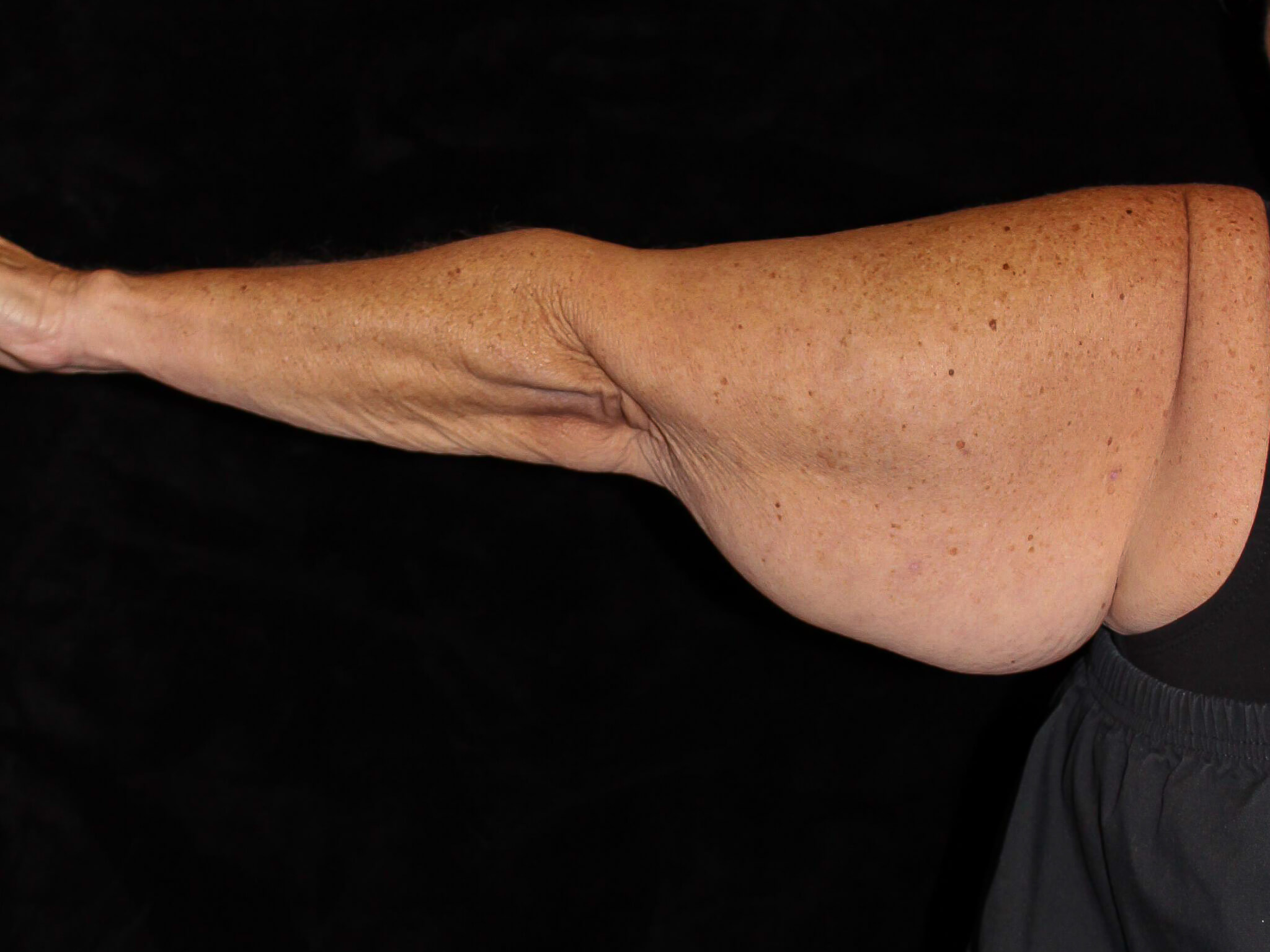 Arm Lift Patient Photo - Case 13374 - before view-1