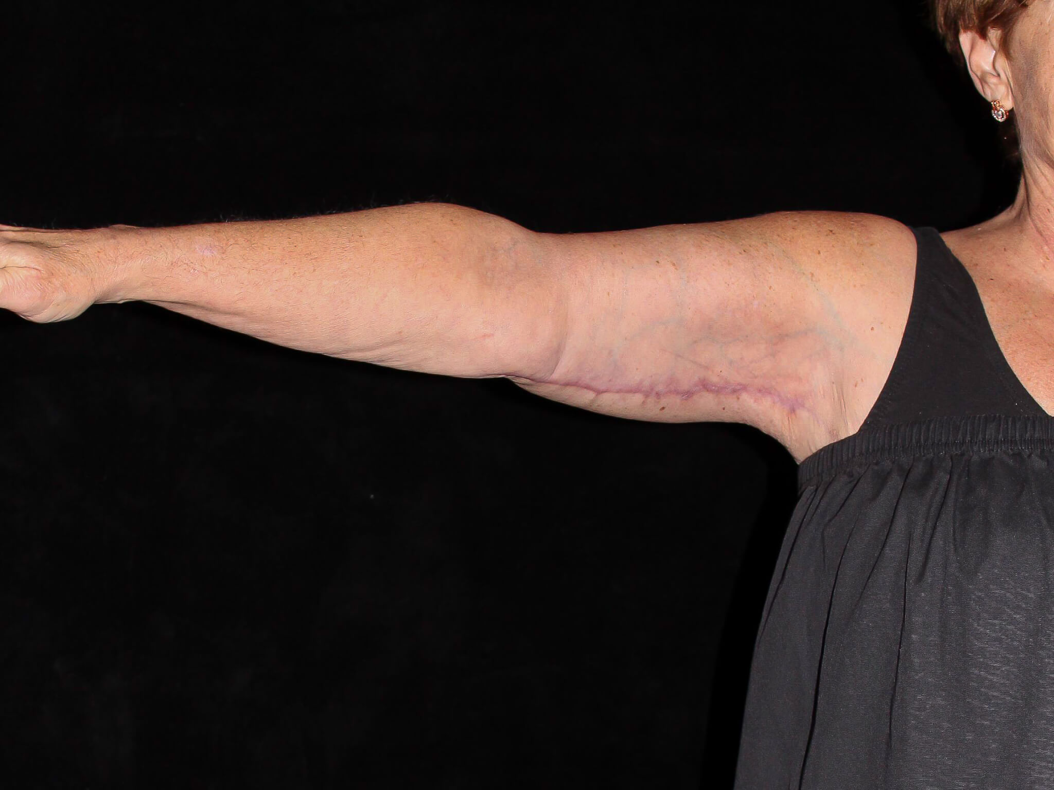 Arm Lift Patient Photo - Case 13374 - after view