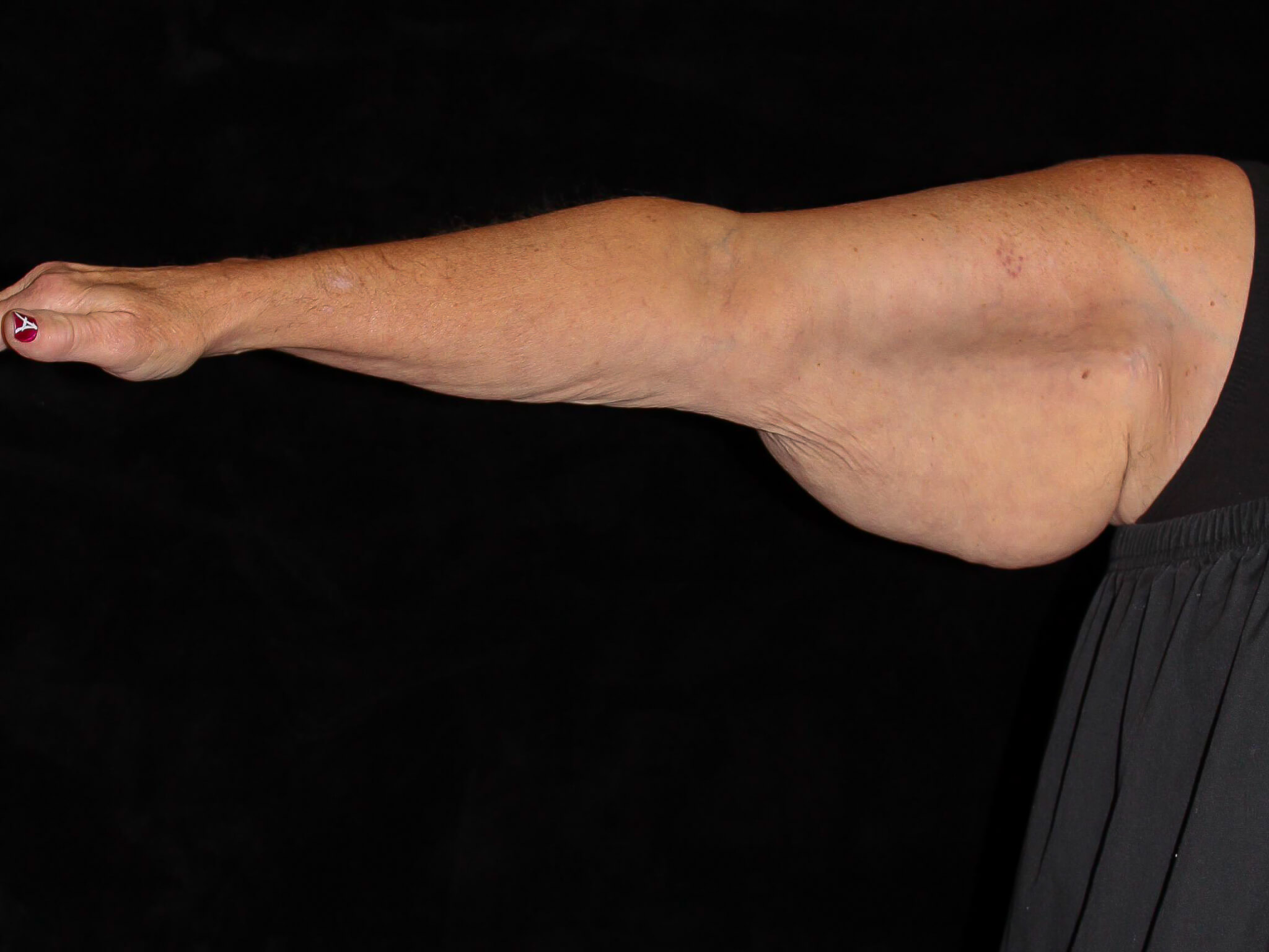 Arm Lift Patient Photo - Case 13374 - before view-