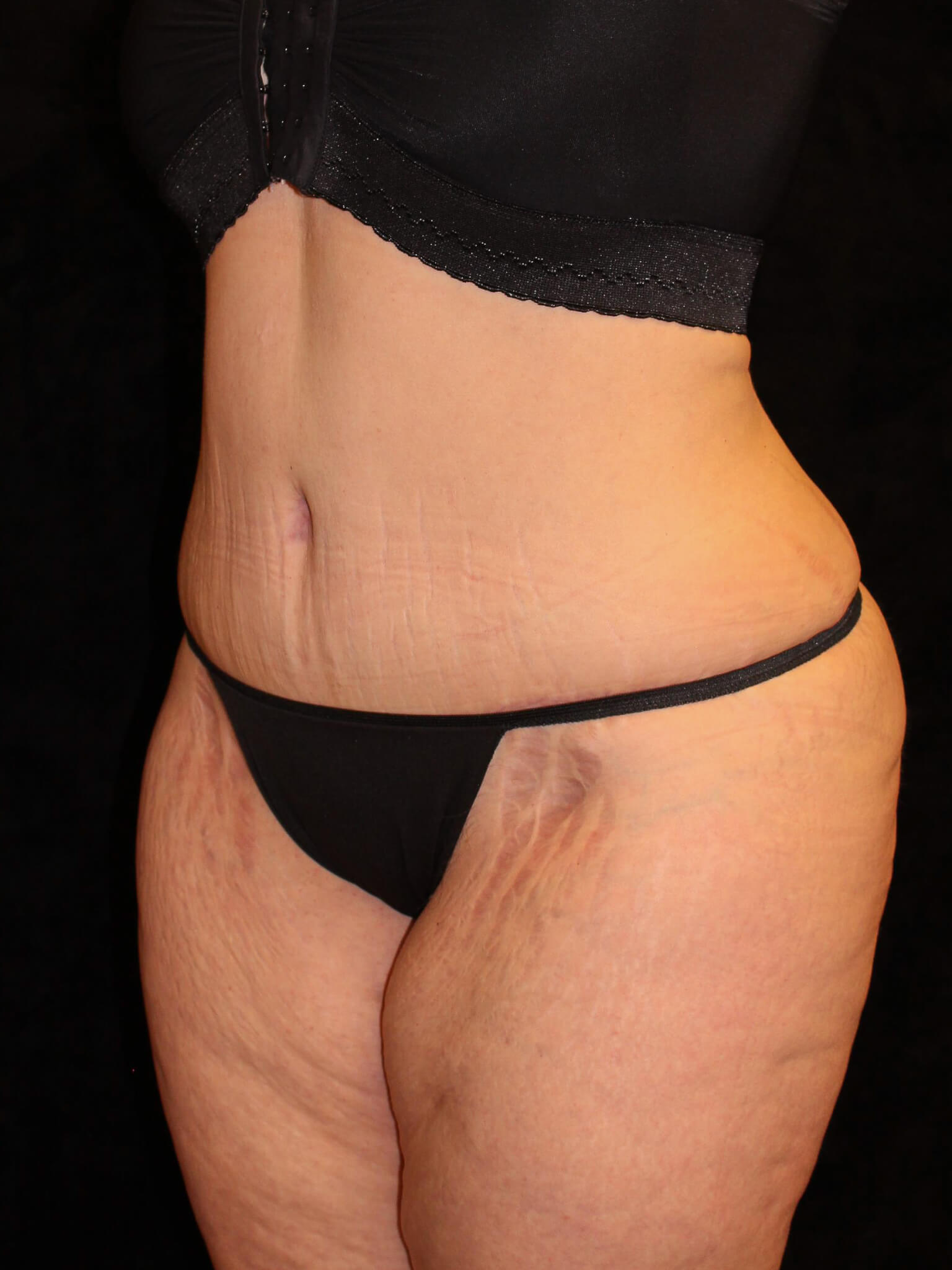 Tummy Tuck Patient Photo - Case 14101 - after view-1