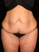 Tummy Tuck - Case 14101 - Before