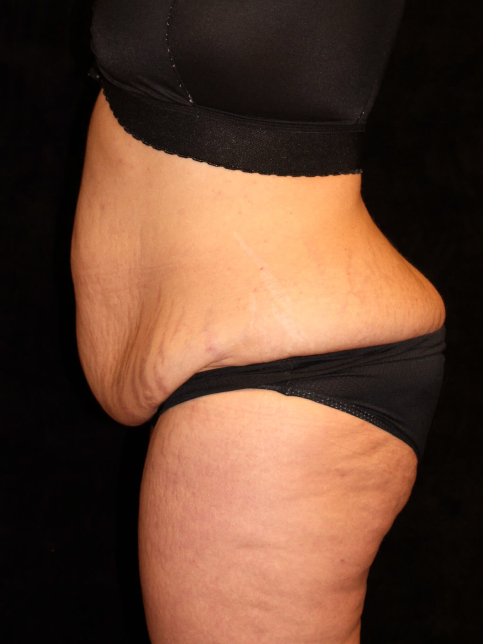 Tummy Tuck Patient Photo - Case 14101 - before view-2