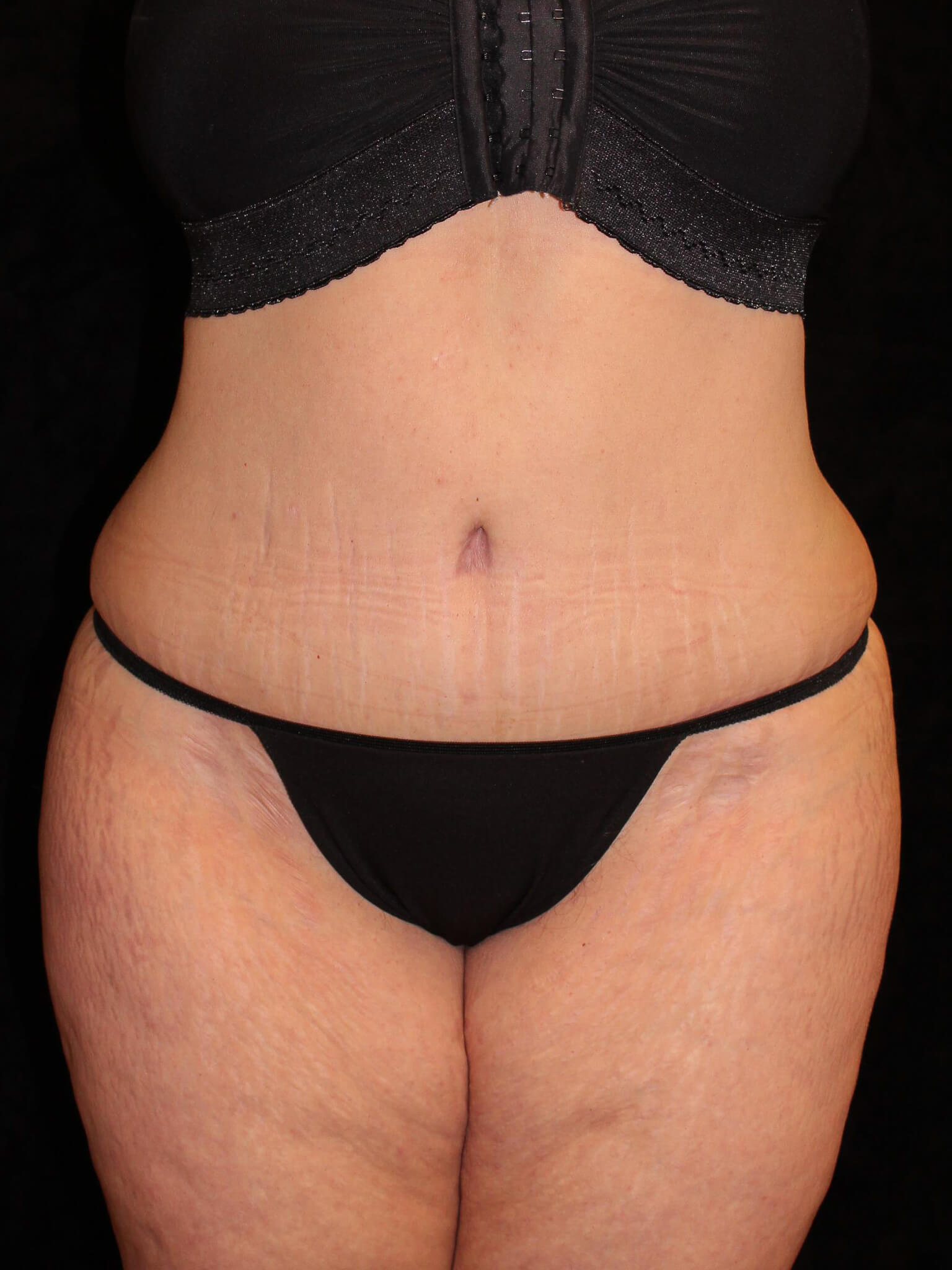 Tummy Tuck Patient Photo - Case 14101 - after view