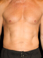 Male Body Contouring - Case 16242 - Before