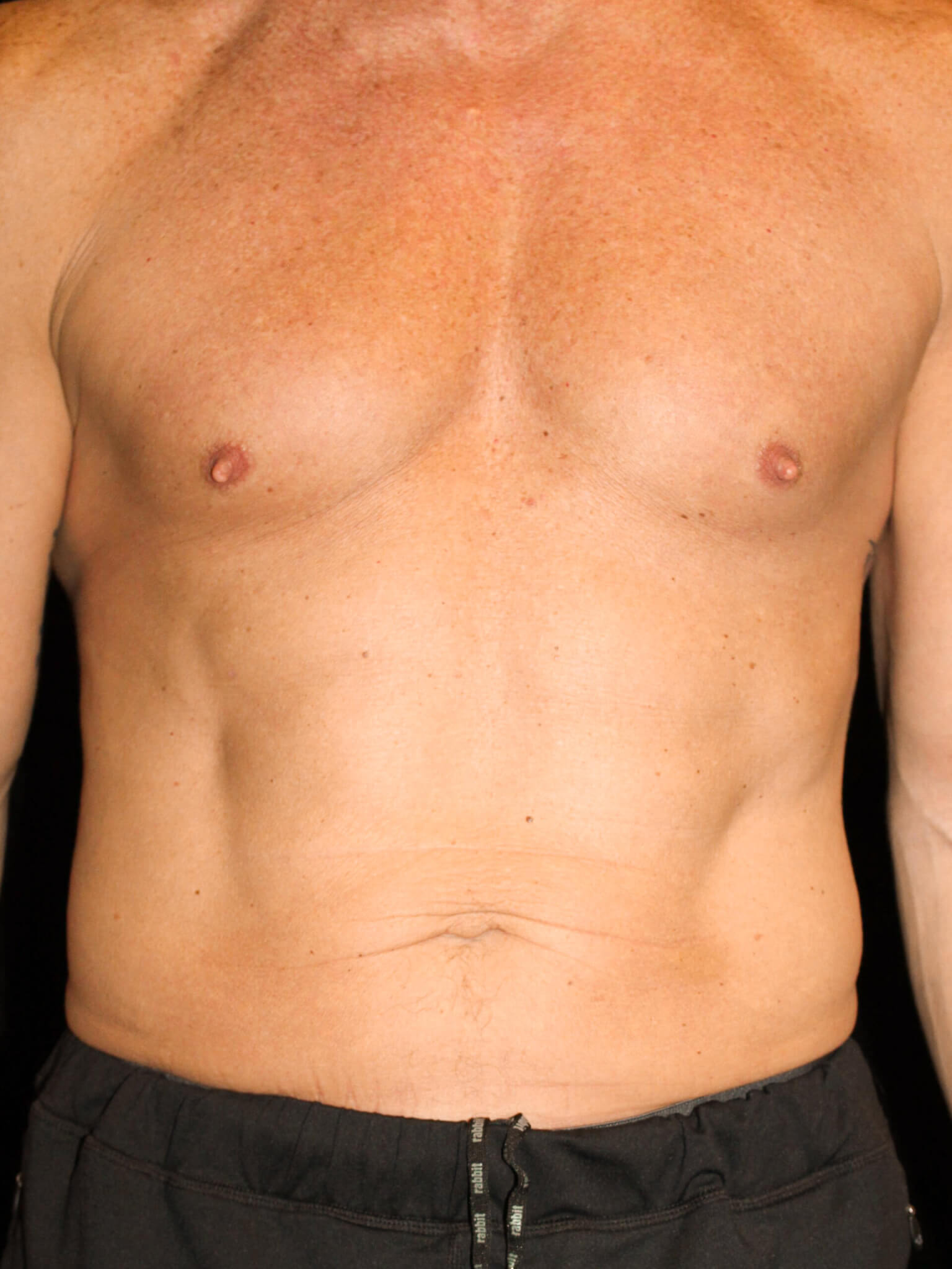 Male Body Contouring Patient Photo - Case 16242 - before view-
