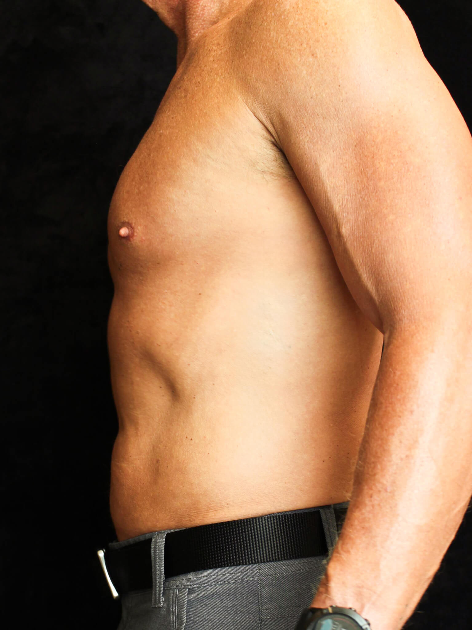 Male Body Contouring Patient Photo - Case 16242 - after view-2