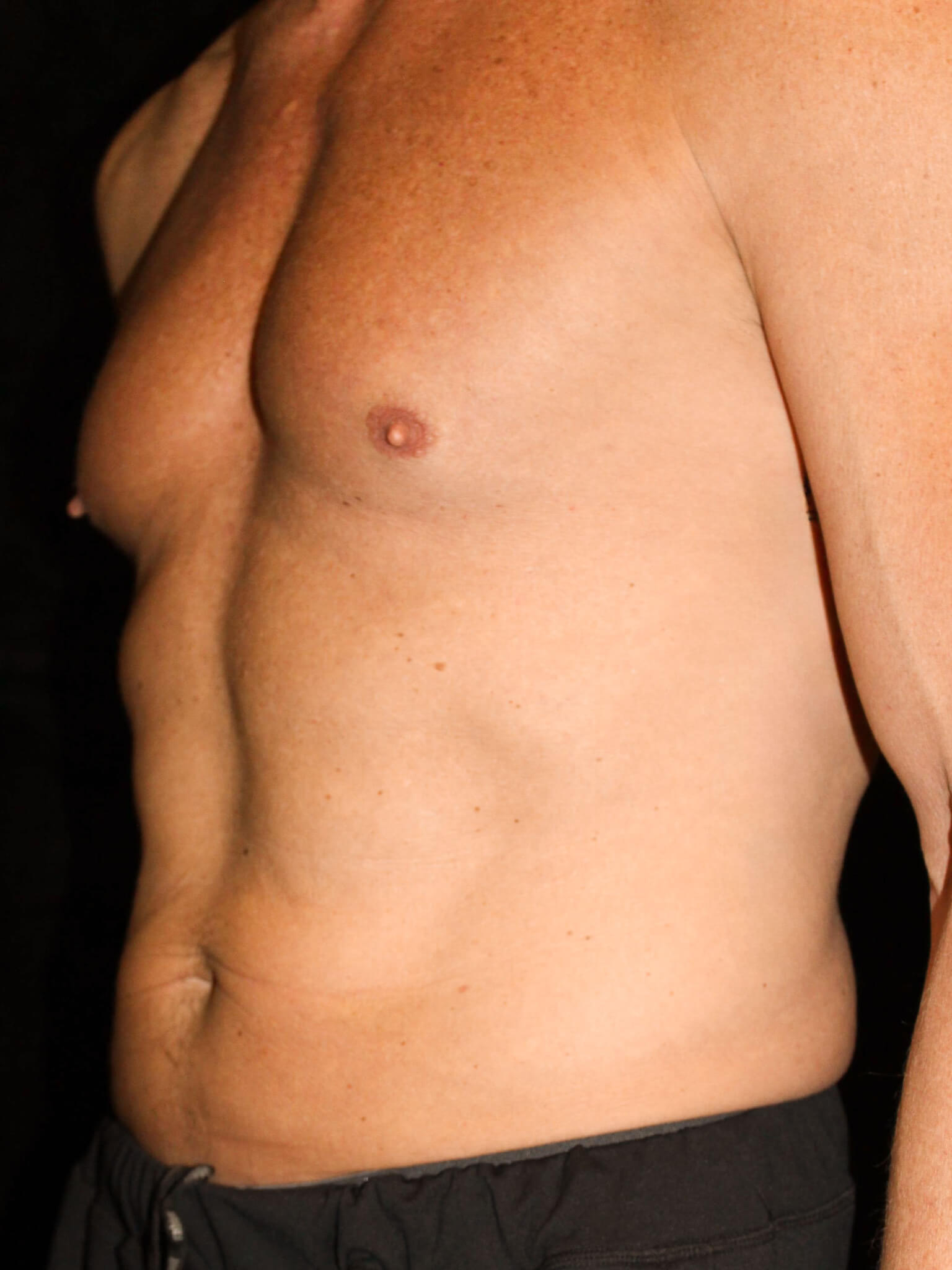 Male Body Contouring Patient Photo - Case 16242 - before view-1