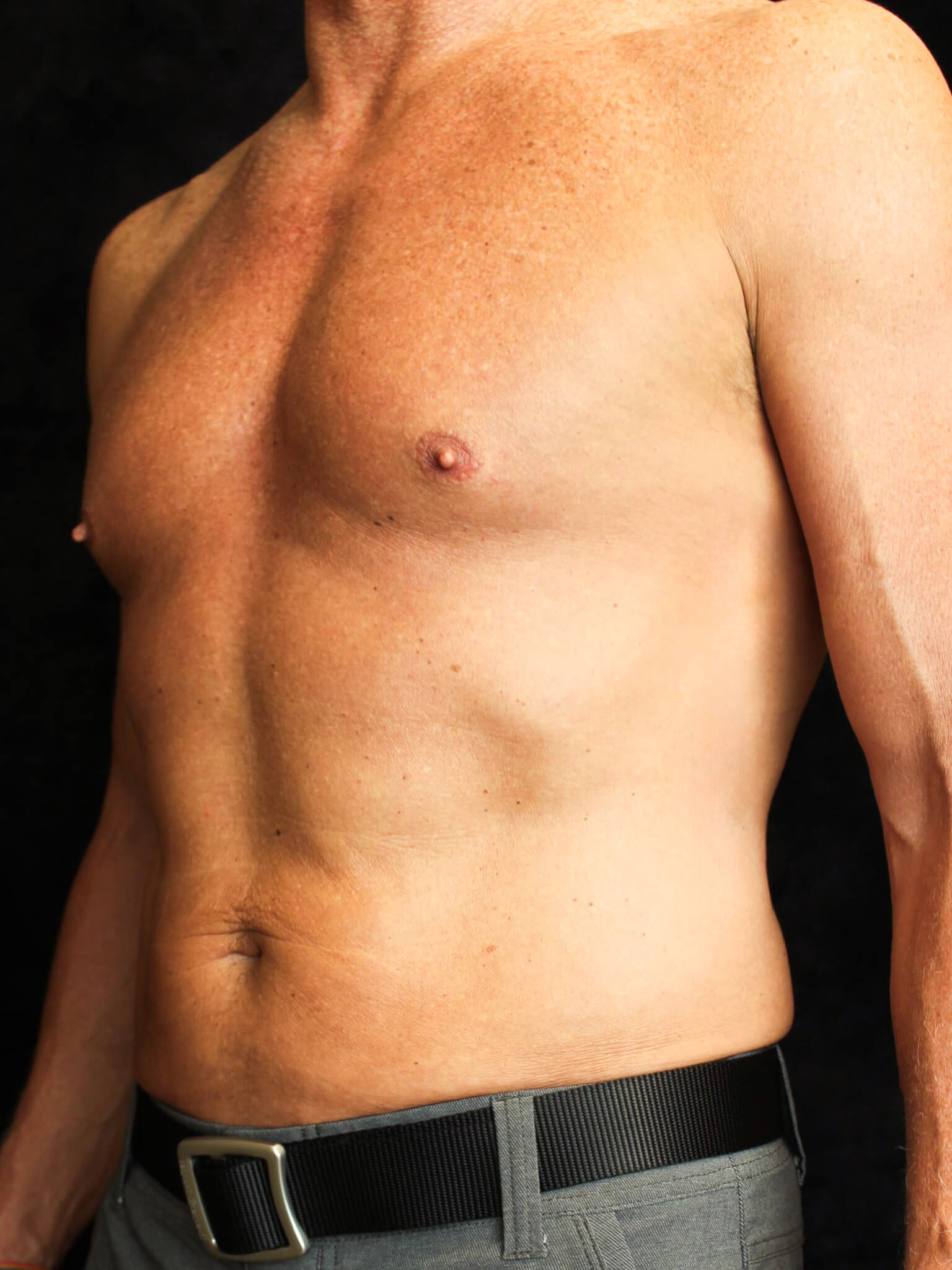 Male Body Contouring Patient Photo - Case 16242 - after view-1