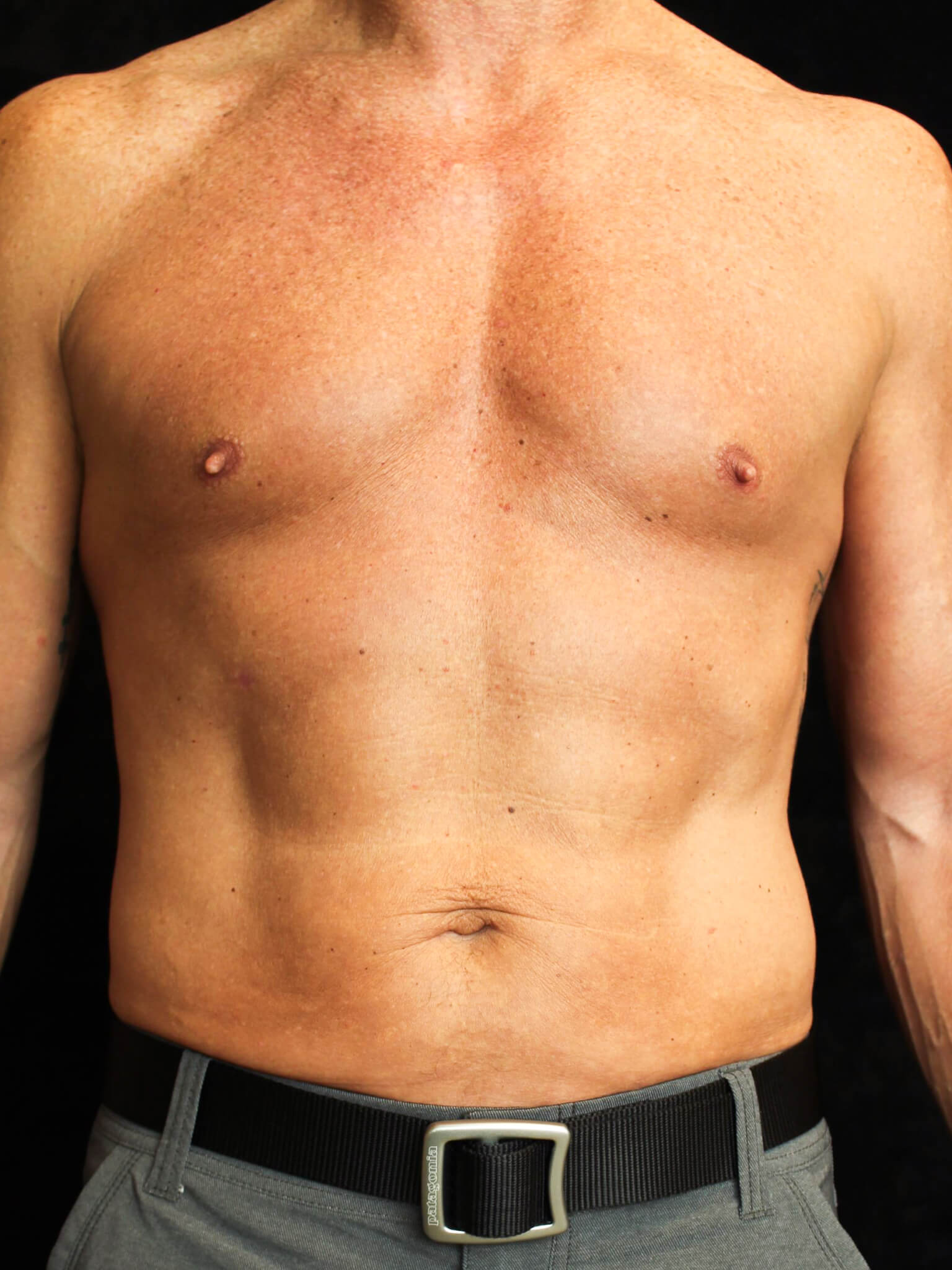 Male Body Contouring Patient Photo - Case 16242 - after view