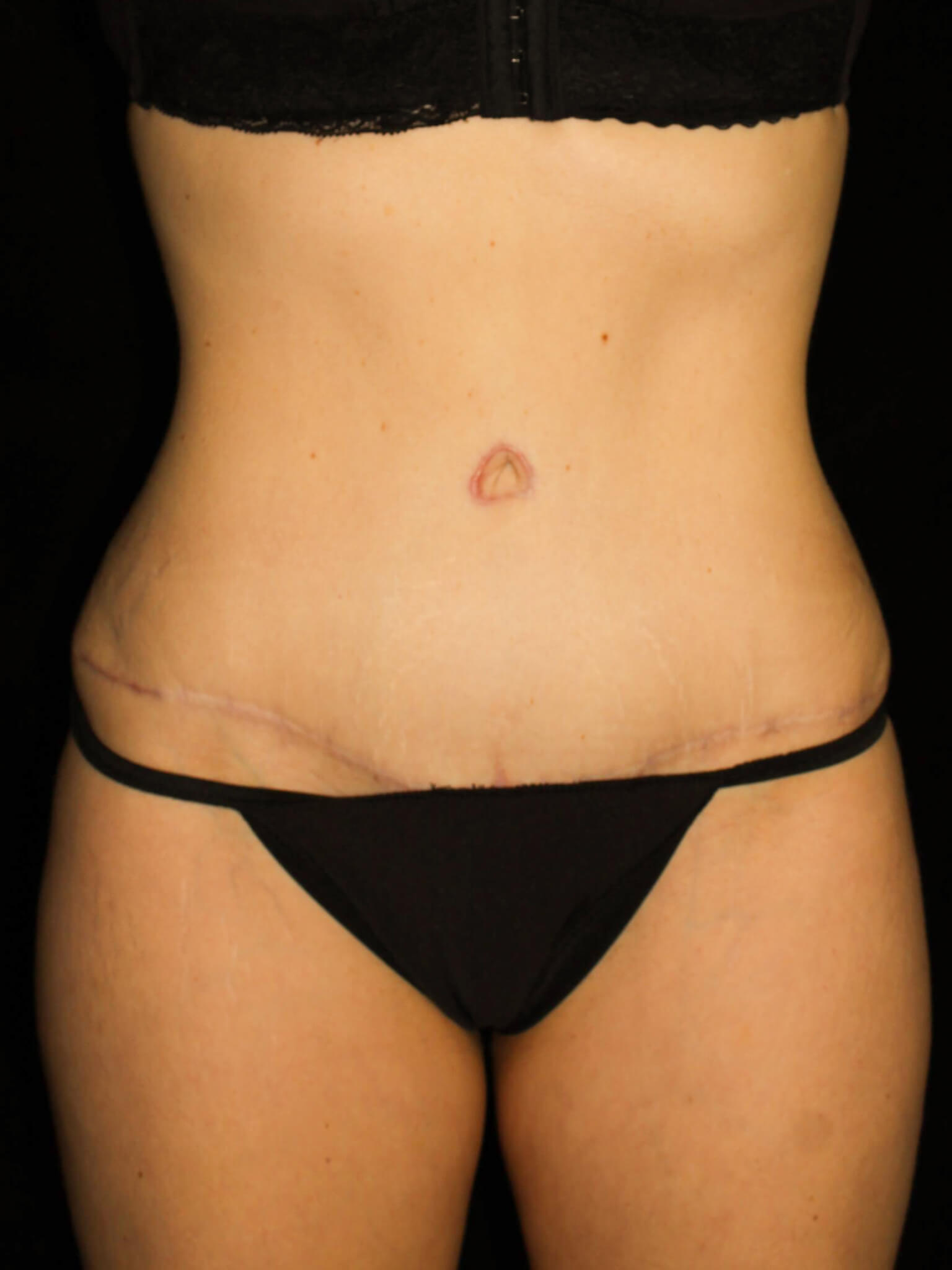 Tummy Tuck Patient Photo - Case 1818 - after view
