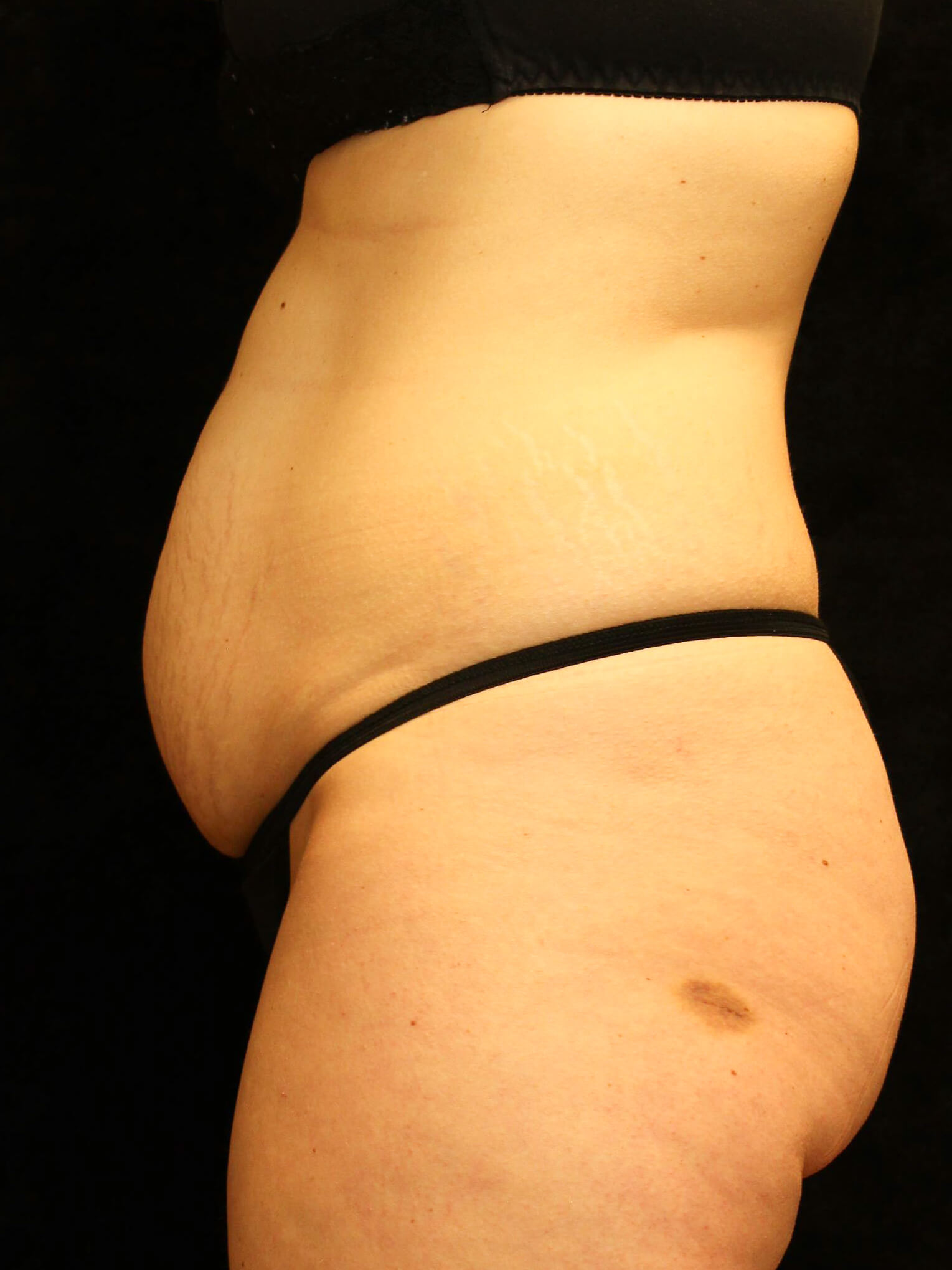 Tummy Tuck Patient Photo - Case 1818 - before view-2