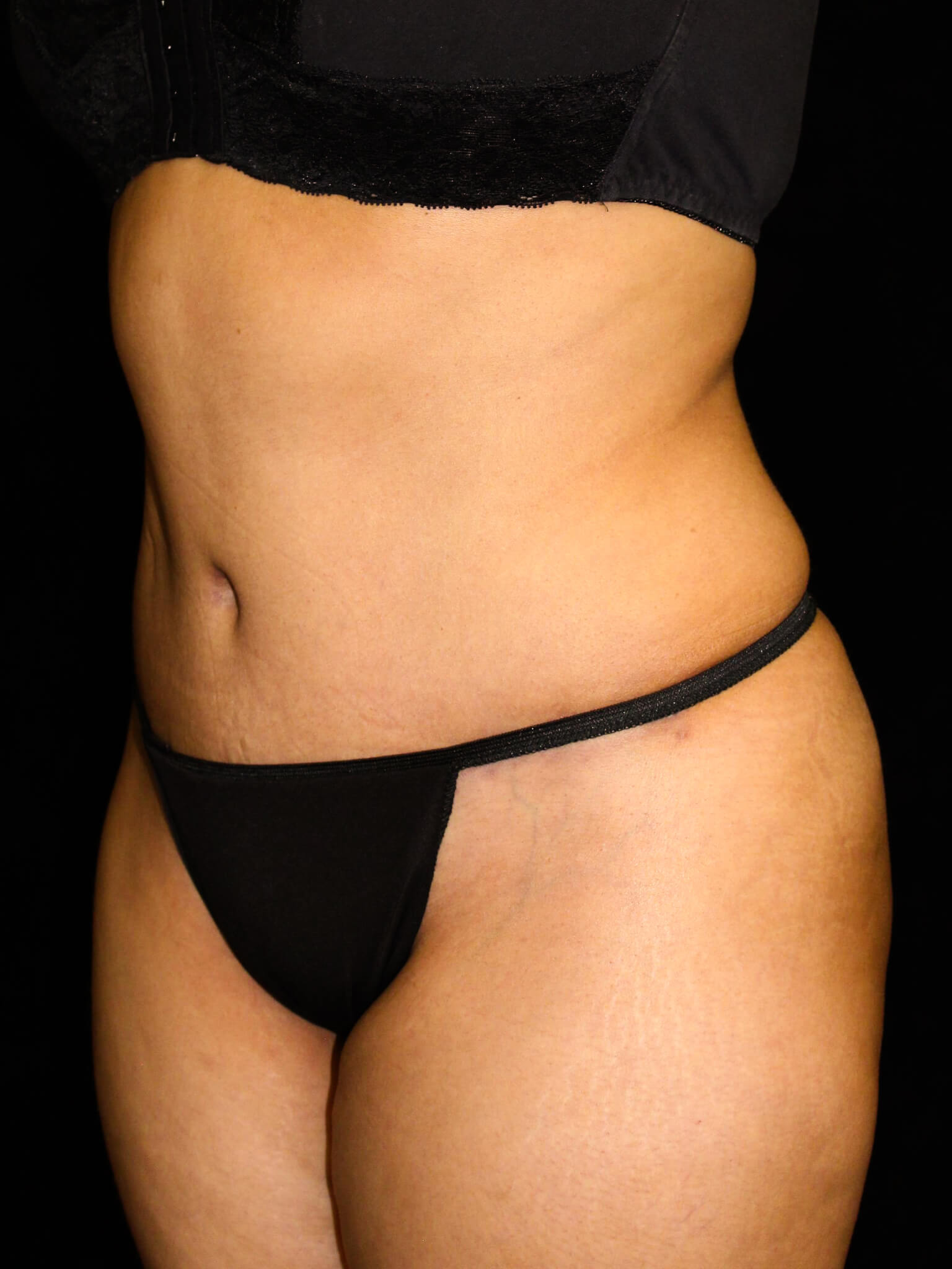Tummy Tuck Patient Photo - Case 16116 - after view-1