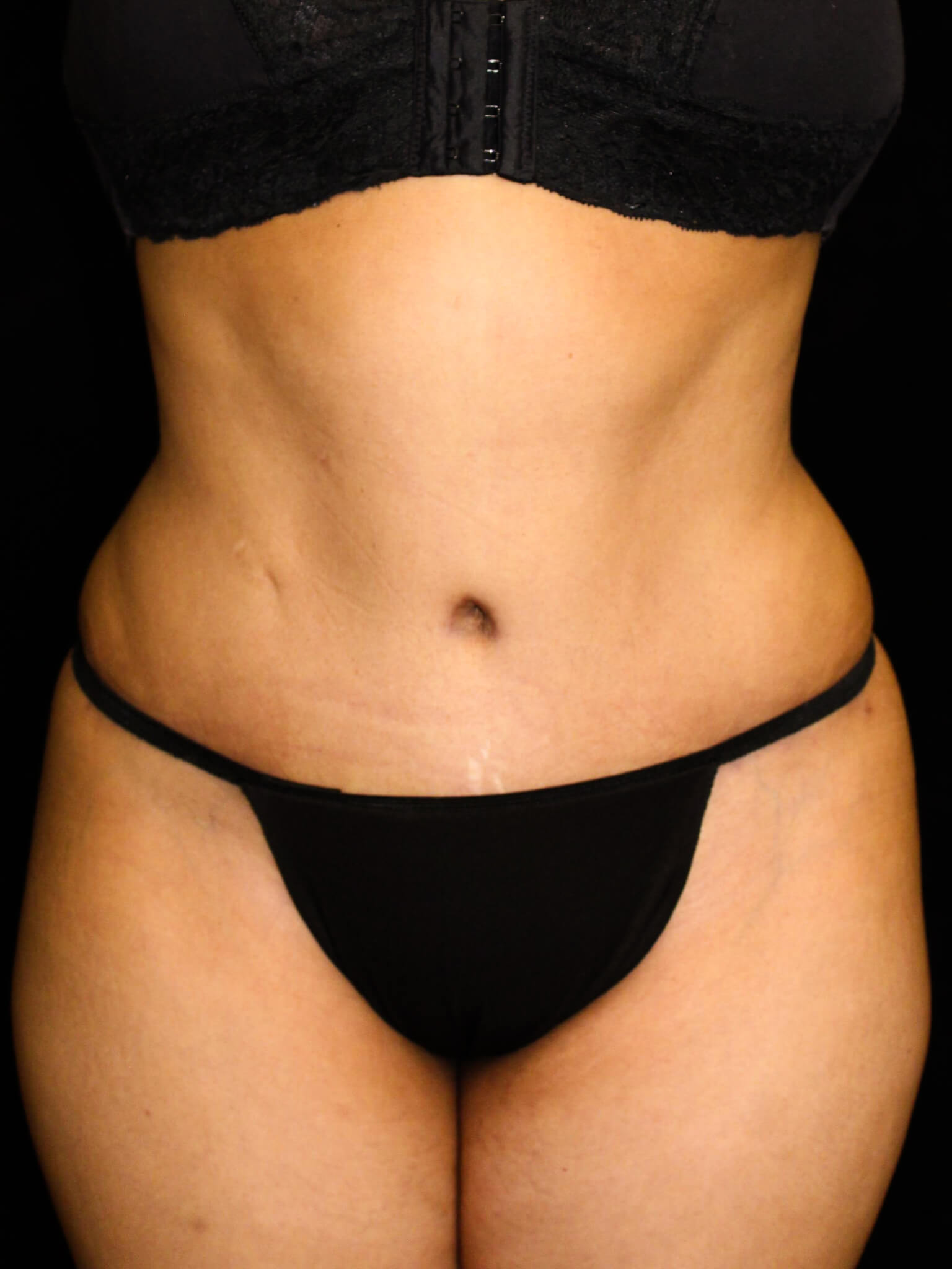 Tummy Tuck Patient Photo - Case 16116 - after view