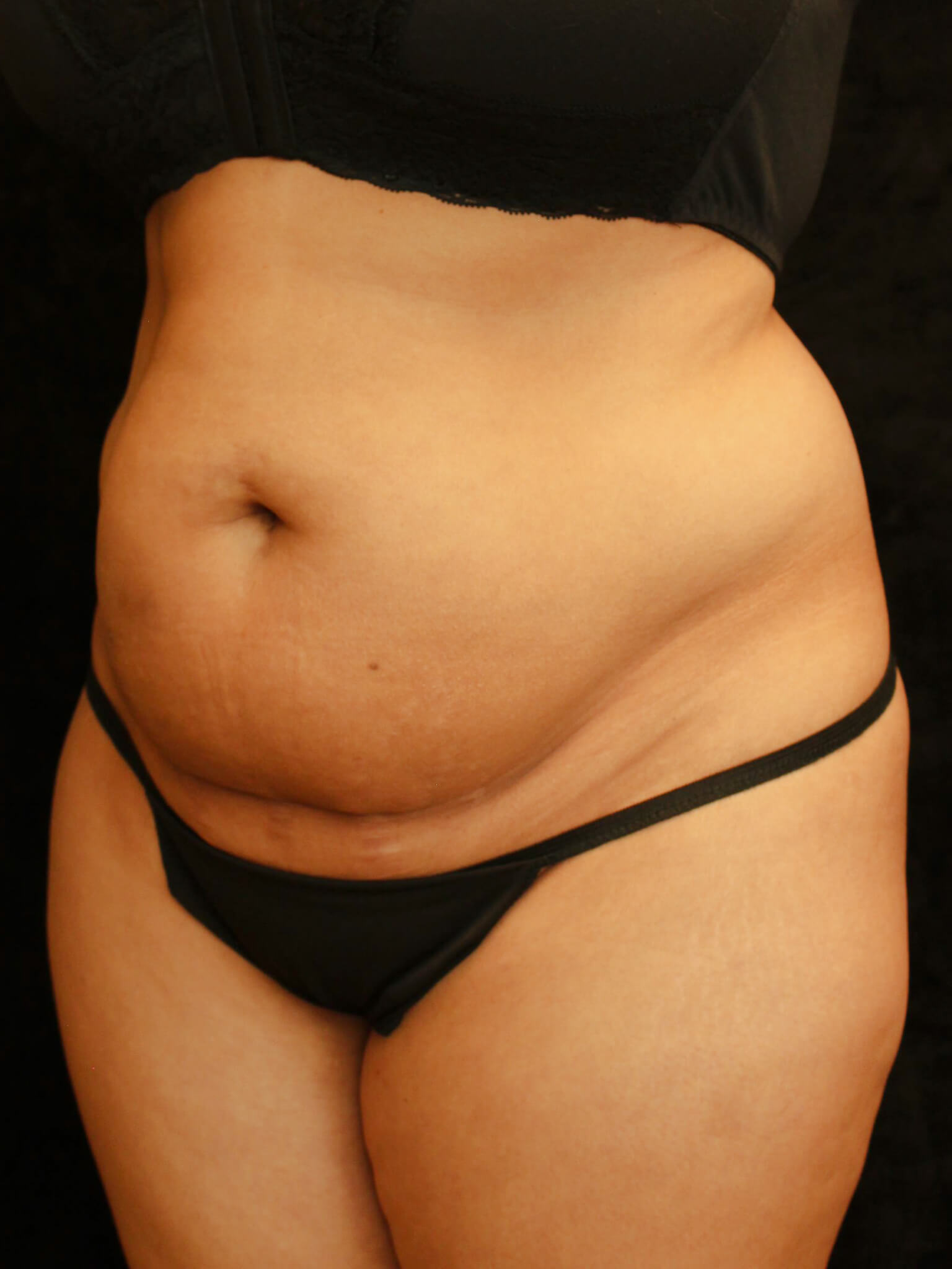 Tummy Tuck Patient Photo - Case 16116 - before view-1