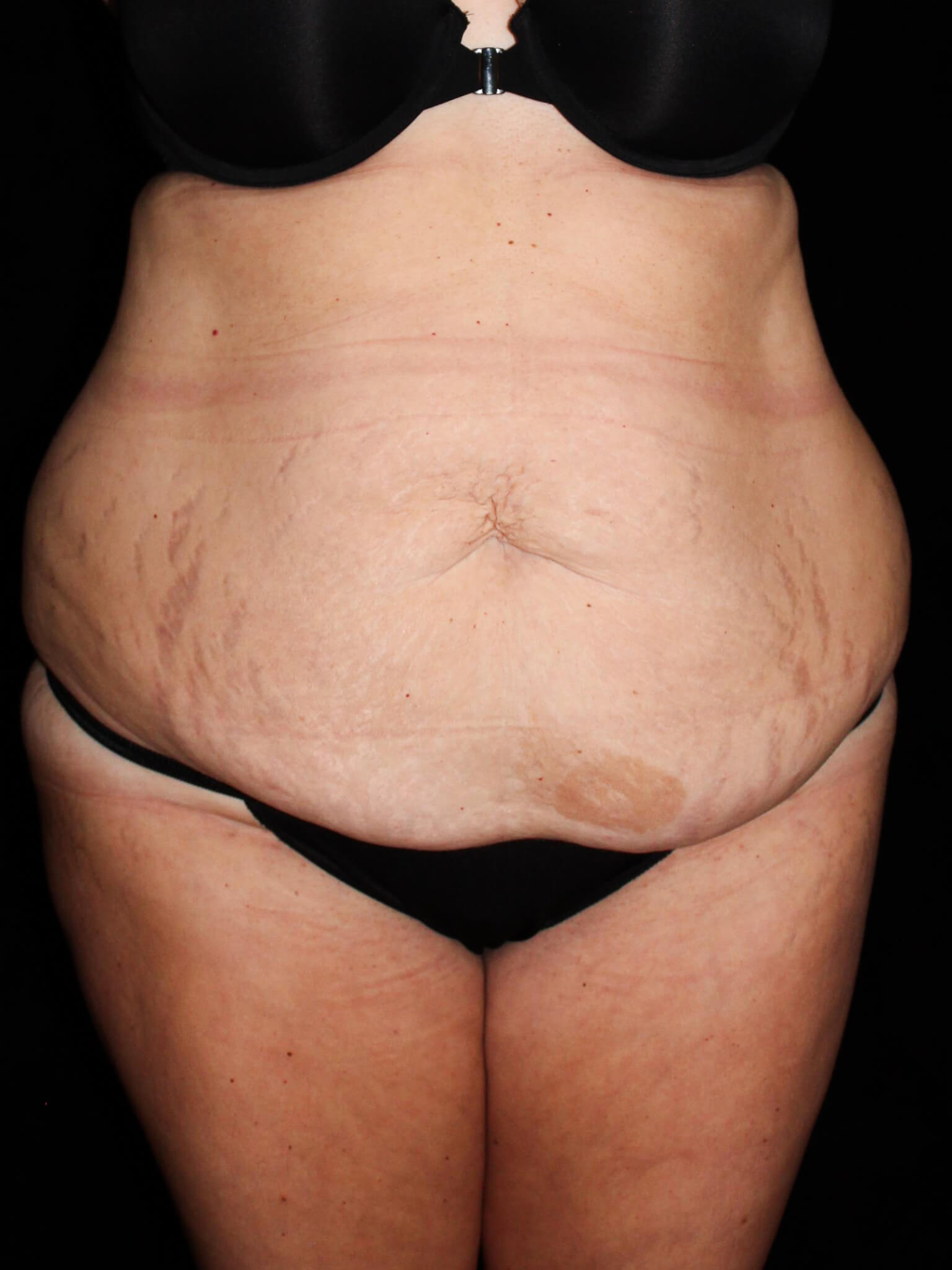 Tummy Tuck Patient Photo - Case 14854 - before view-