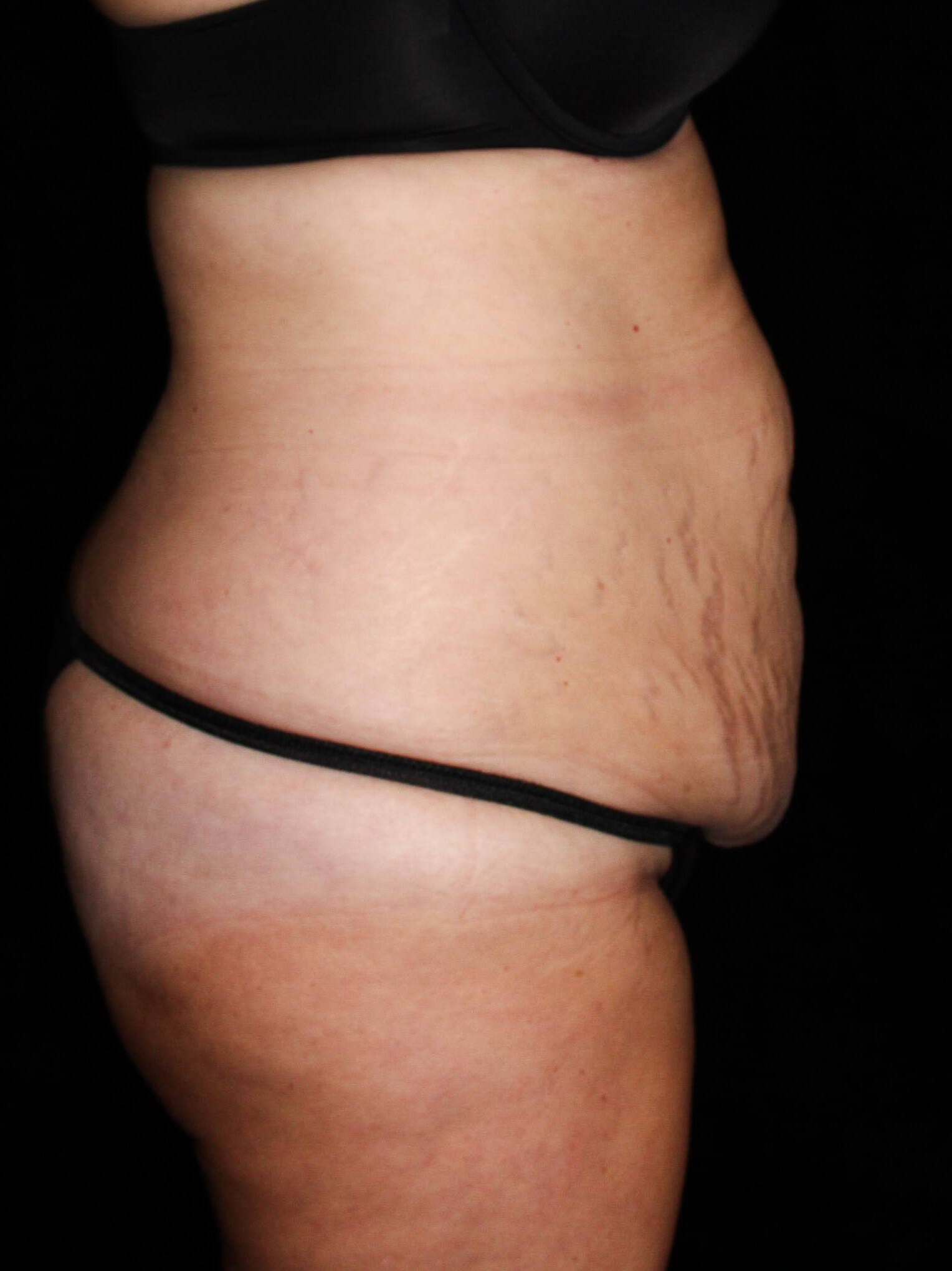 Tummy Tuck Patient Photo - Case 14854 - before view-2