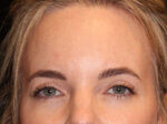 Eyelid Surgery - Case 13871 - Before