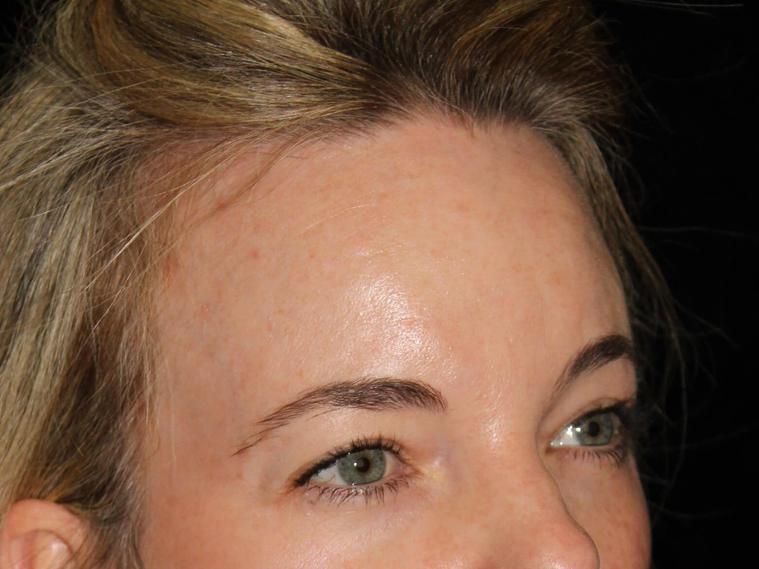 Eyelid Surgery Patient Photo - Case 13871 - before view-1