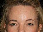Eyelid Surgery - Case 13871 - After