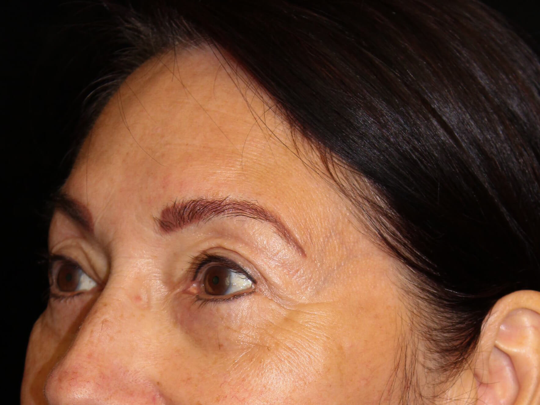 Eyelid Surgery Patient Photo - Case 14713 - after view-2