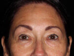 Eyelid Surgery - Case 14713 - Before