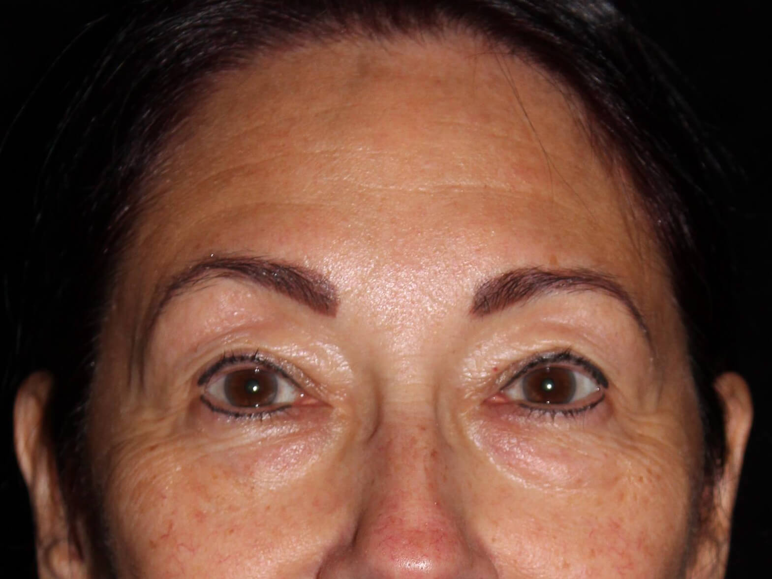 Eyelid Surgery Patient Photo - Case 14713 - before view-