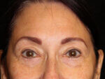 Eyelid Surgery - Case 14713 - After