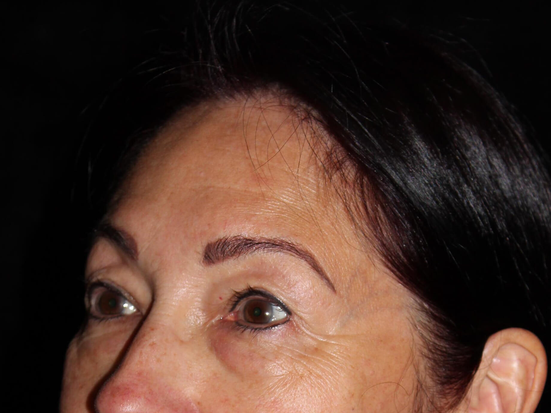 Eyelid Surgery Patient Photo - Case 14713 - before view-2