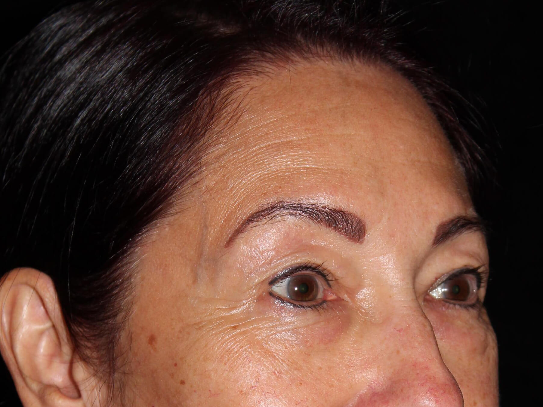 Eyelid Surgery Patient Photo - Case 14713 - before view-1