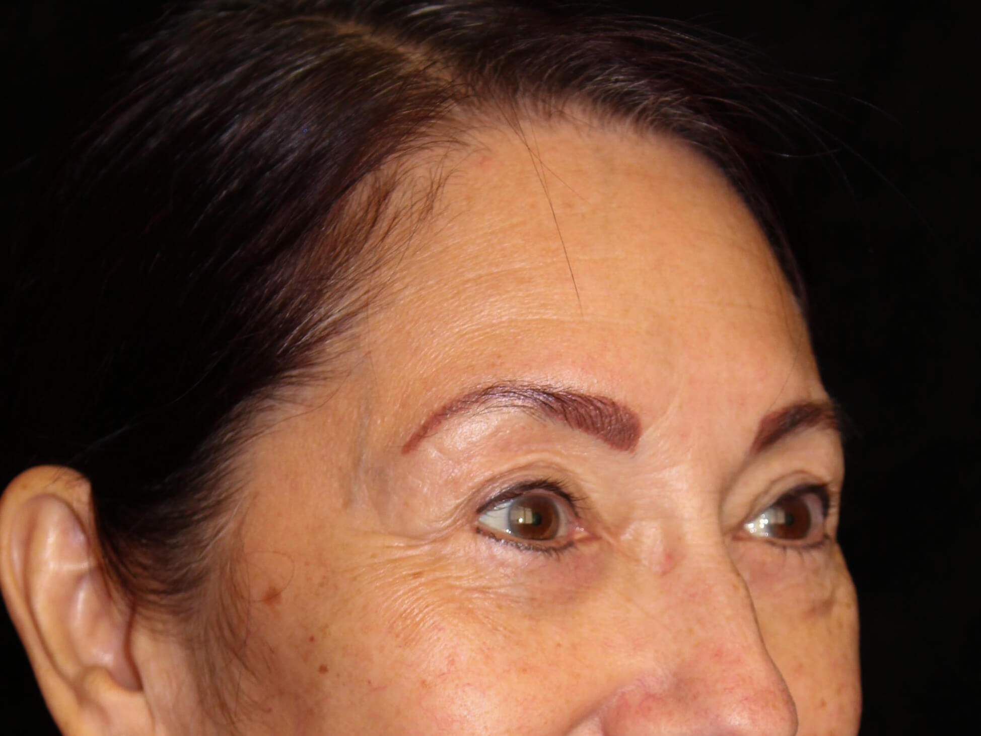 Eyelid Surgery Patient Photo - Case 14713 - after view-1