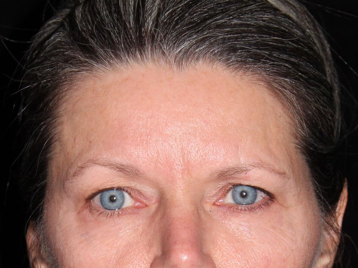 Eyelid Surgery Patient Photo - Case 6954 - before view-1